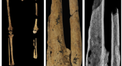 a, TB1 left and right legs with pelvic girdle, demonstrating the complete absence of the distal third of the left lower leg. b, Left tibia and fibula showing the amputation surface, atrophy and necrosis. The bone surface is more porous because lysis occurred to remove the dead bone (necrosis). c, Radiograph of the left tibia and fibula. (Maloney et al, 2022)